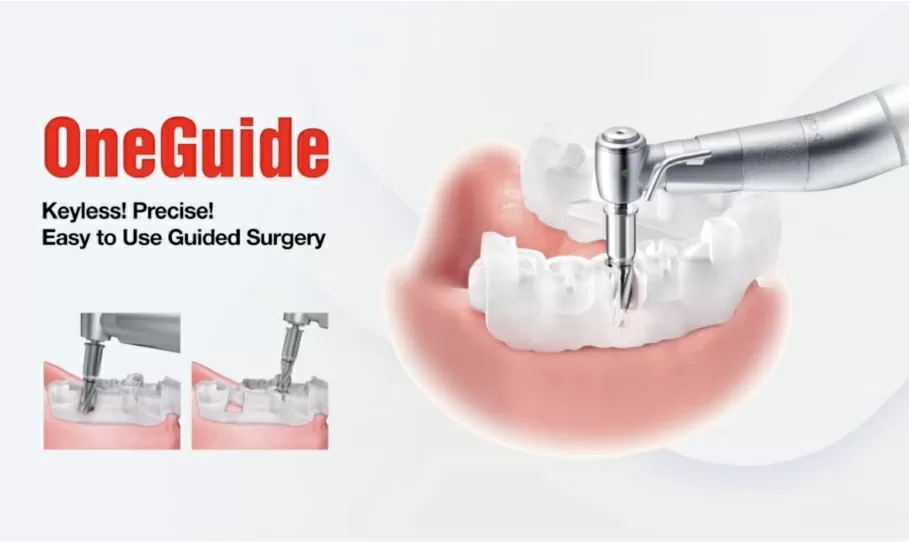 デジタルインプラント／ガイド手術（ワンガイド等）