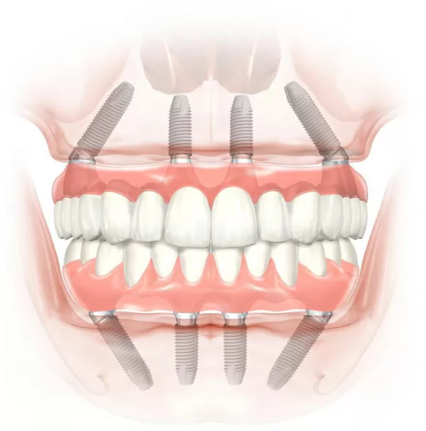 一般的なインプラント治療とオールオン4（All-on-4）の違い