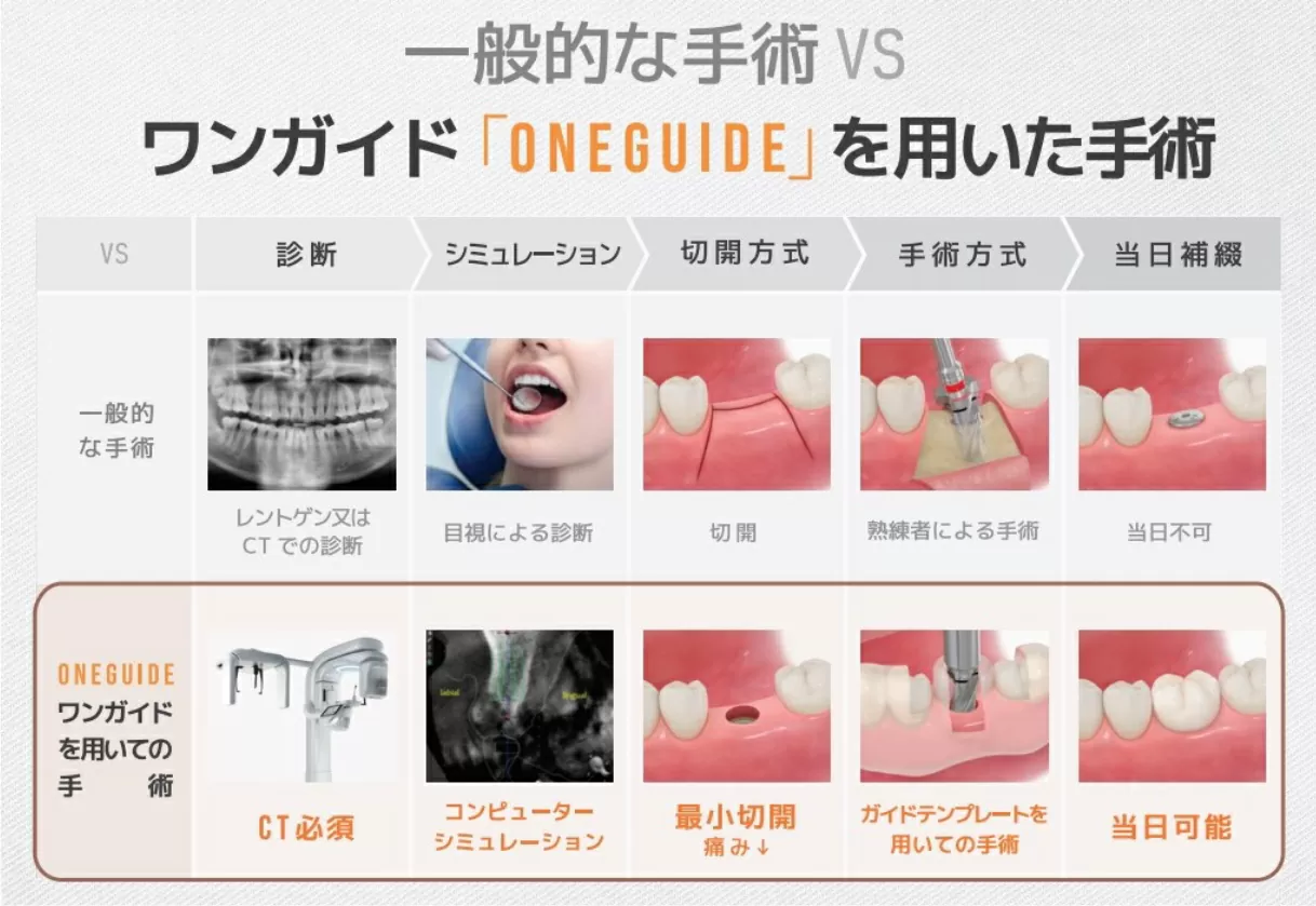 デジタルインプラント／ガイド手術（ワンガイド等）