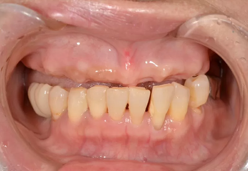 オールオン4の症例紹介