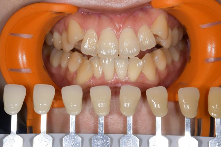 ホワイトニング症例