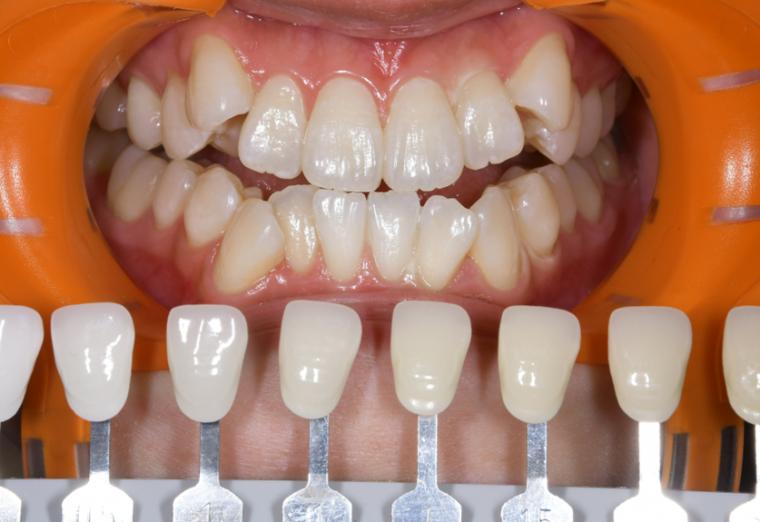 ホワイトニング症例