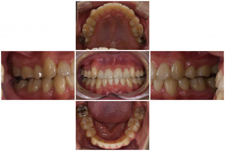 ハイブリット矯正　症例