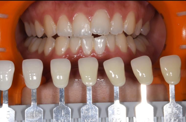 ホワイトニング　症例