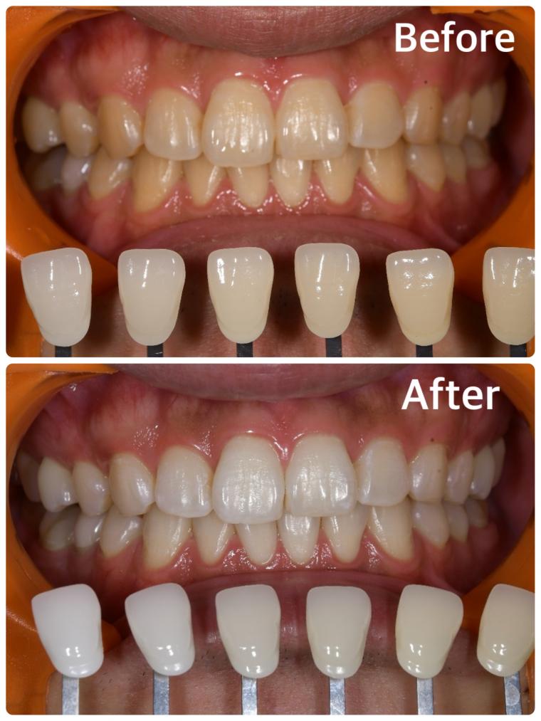 20代男性｜オフィスホワイトニング5回コース