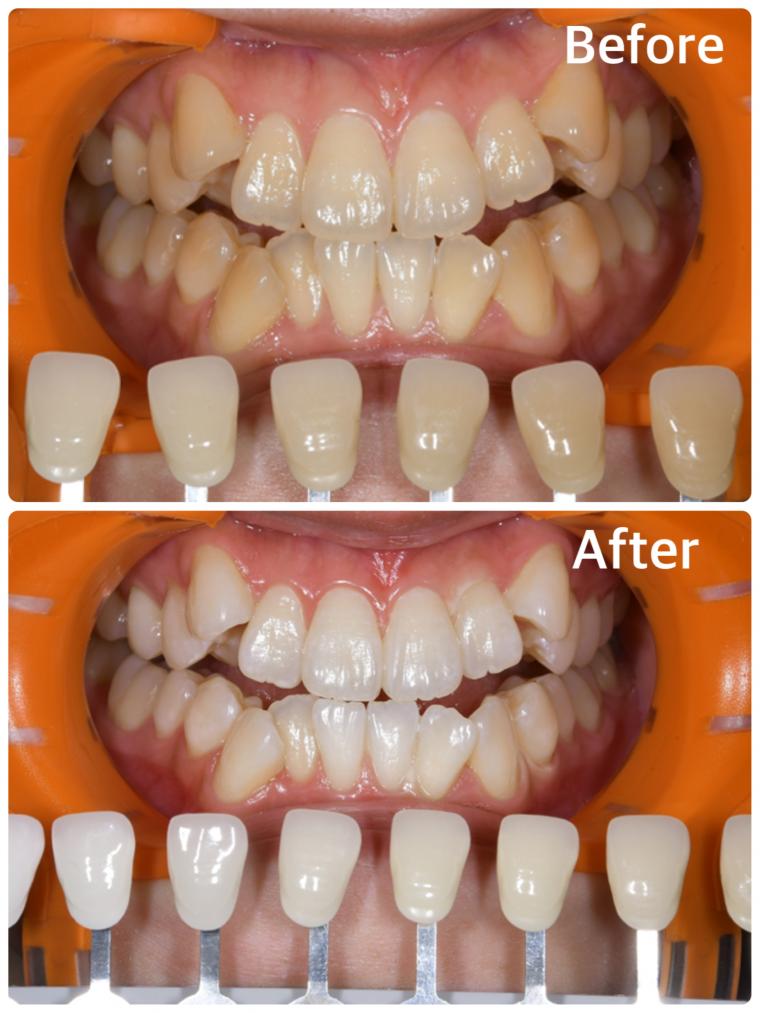 30代男性｜オフィスホワイトニング5回コース