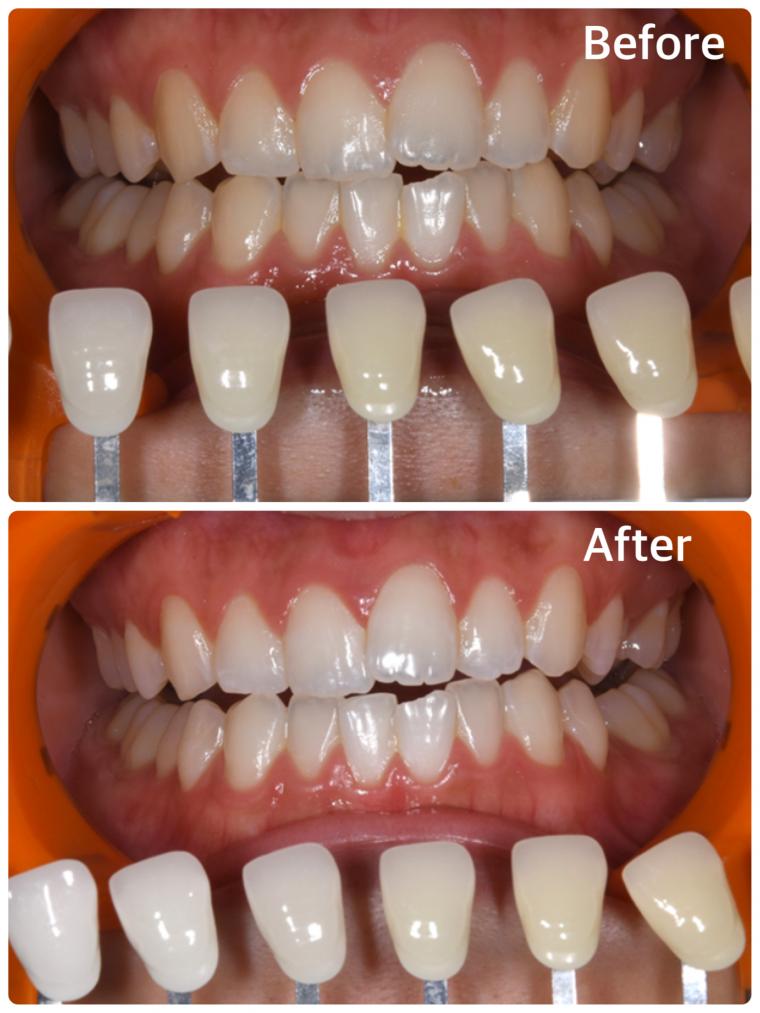 20代女性｜オフィスホワイトニング5回コース