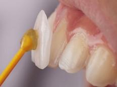 セラミック・ジルコニアってよく聞くけどどんな素材？