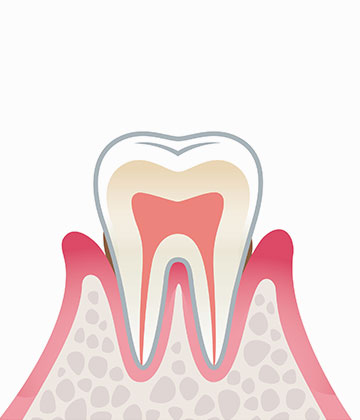 歯周炎（軽度）