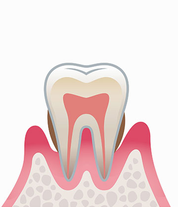 歯周炎（中度）