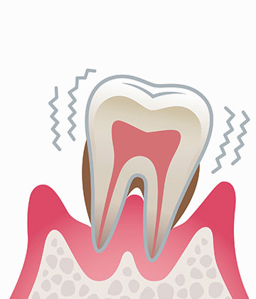 歯周炎（重度）