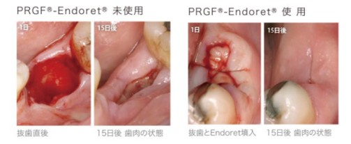 PRGFを用いた症例